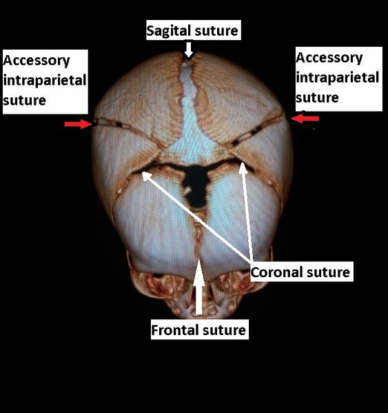 File:Accessory intraparietal suture (Radiopaedia 50584-56021 3D reconstruction 8).jpg