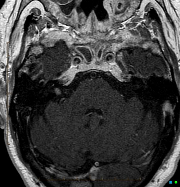 File:Acoustic schwannoma - intracanalicular (Radiopaedia 2675-6388 Axial T1 C+ 1).jpg