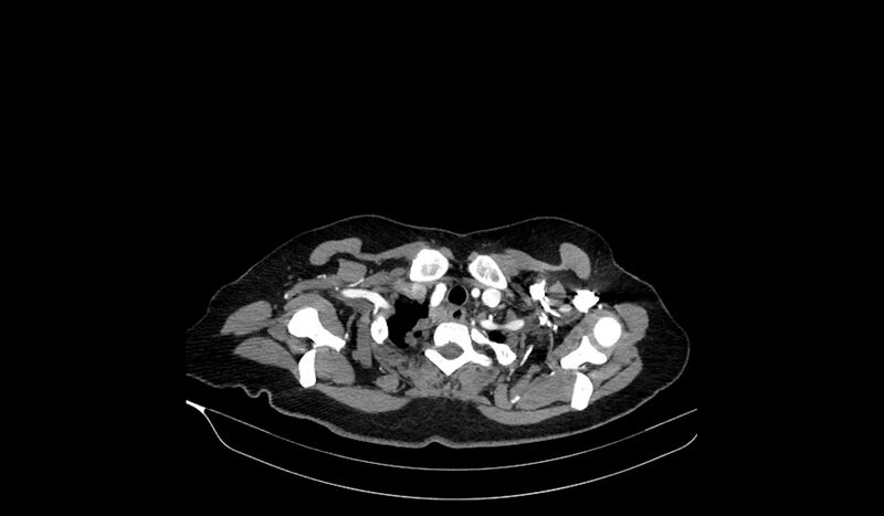 File:Acquired tracheo-esophageal fistula (Radiopaedia 51356-57103 Axial C+ arterial phase 14).jpg