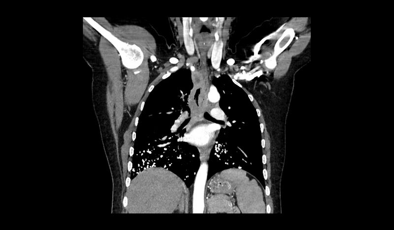 File:Acquired tracheo-esophageal fistula (Radiopaedia 51356-57103 Coronal C+ arterial phase 8).jpg