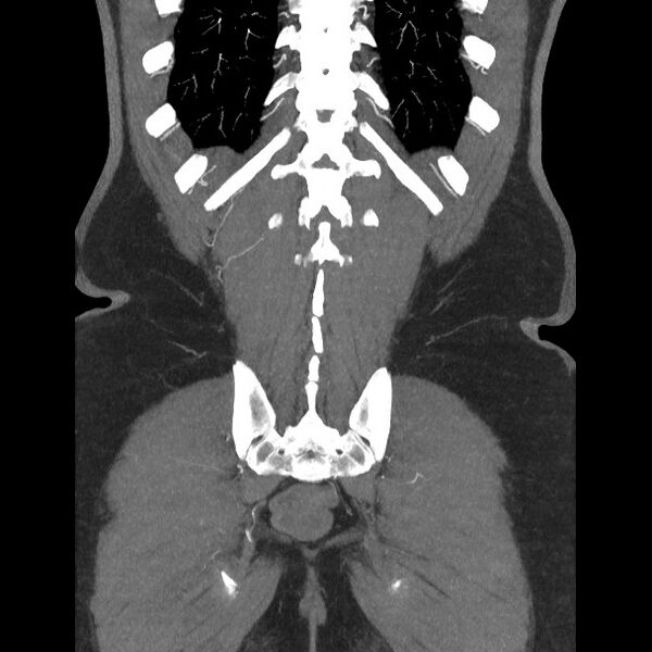 File:Active colonic bleed on CT (Radiopaedia 49765-55025 Coronal art MIP 52).jpg