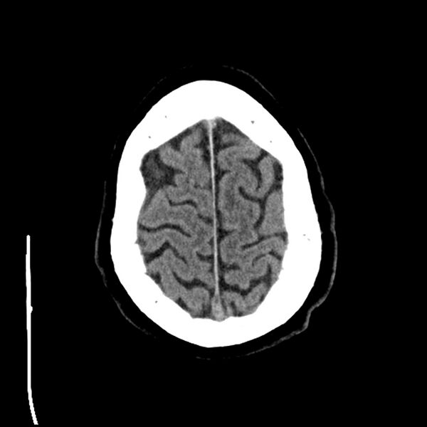 File:Acute A3 occlusion with ACA ischemic penumbra (CT perfusion) (Radiopaedia 72036-82525 Axial non-contrast 40).jpg