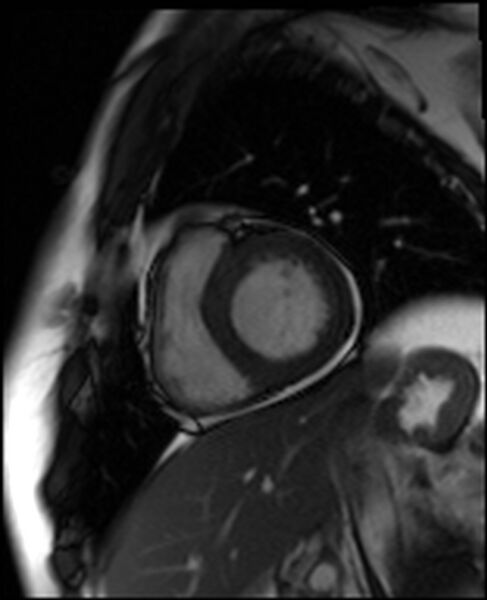 File:Acute anteroseptal myocardial infarction (Radiopaedia 68409-77944 Short axis (basal) SSFP cine 1).jpg