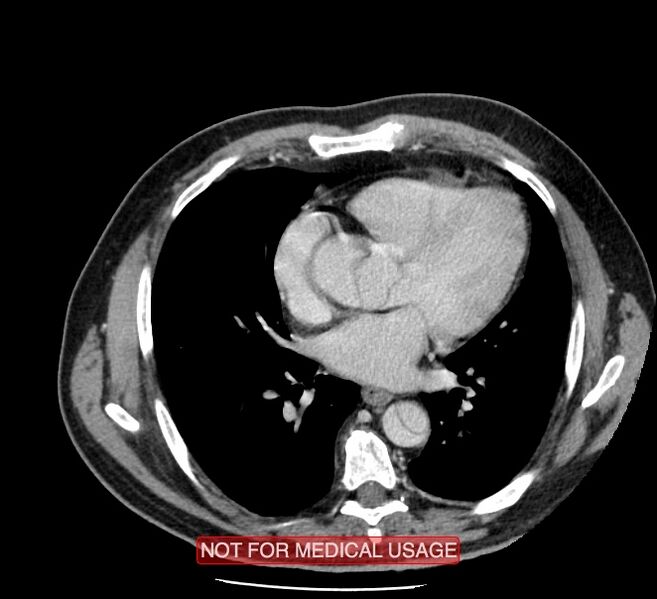 File:Acute aortic dissection - Stanford type A (Radiopaedia 40661-43285 Axial C+ portal venous phase 33).jpg
