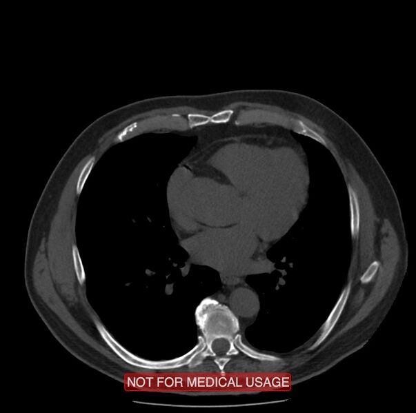 File:Acute aortic dissection - Stanford type A (Radiopaedia 40661-43285 Axial non-contrast 36).jpg