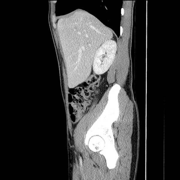 File:Acute appendicitis (Radiopaedia 27049-27227 Sagittal C+ portal venous phase 20).jpg