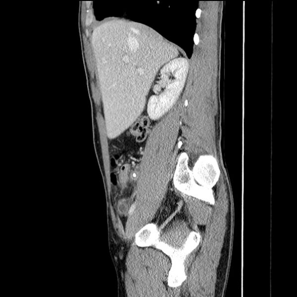 File:Acute appendicitis (Radiopaedia 27049-27227 Sagittal C+ portal venous phase 26).jpg