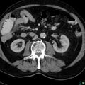 Acute appendicitis arising from a malrotated cecum (Radiopaedia 19970-19997 Axial C+ portal venous phase 13).jpg