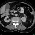 Acute appendicitis arising from a malrotated cecum (Radiopaedia 19970-19997 Axial C+ portal venous phase 9).jpg