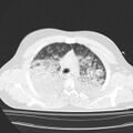 Acute aspiration pneumonitis (Radiopaedia 33605-34703 Axial lung window 33).jpg