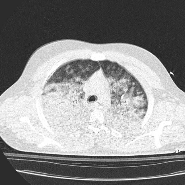 File:Acute aspiration pneumonitis (Radiopaedia 33605-34703 Axial lung window 33).jpg