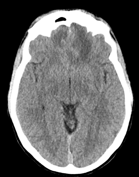 File:Acute disseminated encephalomyelitis (ADEM) (Radiopaedia 65319-74348 Axial non-contrast 15).png