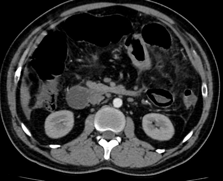 File:Acute mesenteric ischemia - superior mesenteric artery thrombosis (Radiopaedia 73947-84776 Axial C+ arterial phase 46).jpg