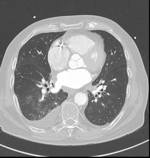 File:Acute myocardial infarction (Radiopaedia 23413-23481 lung window 39).jpg