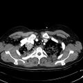 Acute myocardial infarction in CT (Radiopaedia 39947-42415 Axial C+ arterial phase 22).jpg