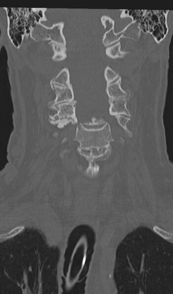 File:Acute on chronic subdural hematoma and thoracic vertebral injury in a multitrauma patient (Radiopaedia 31698-32619 Coronal bone window 23).jpg