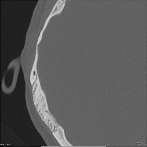 File:Acute otomastoiditis (Radiopaedia 28276-28512 Axial PTB bone window reformat 9).jpg