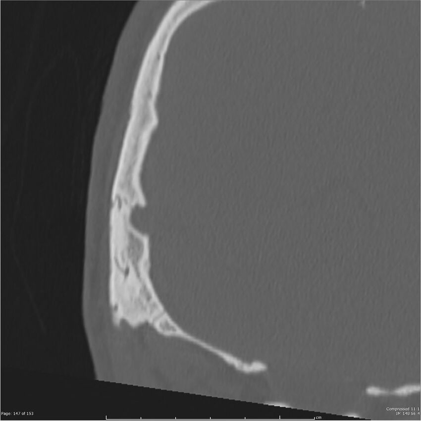 Acute otomastoiditis (Radiopaedia 28276-28512 Coronal PTB bone window reformat 78).jpg