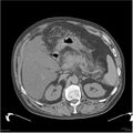 Acute pancreatitis (Radiopaedia 19135-19116 Axial non-contrast 13).jpg