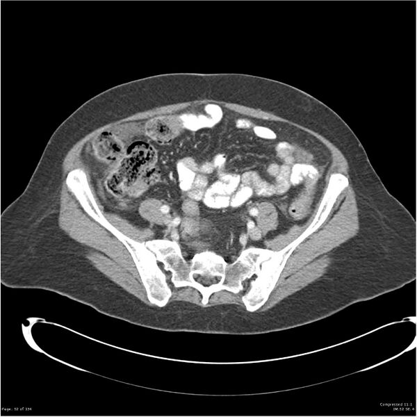 File:Acute pancreatitis (Radiopaedia 19136-19117 Axial C+ portal venous phase 32).jpg