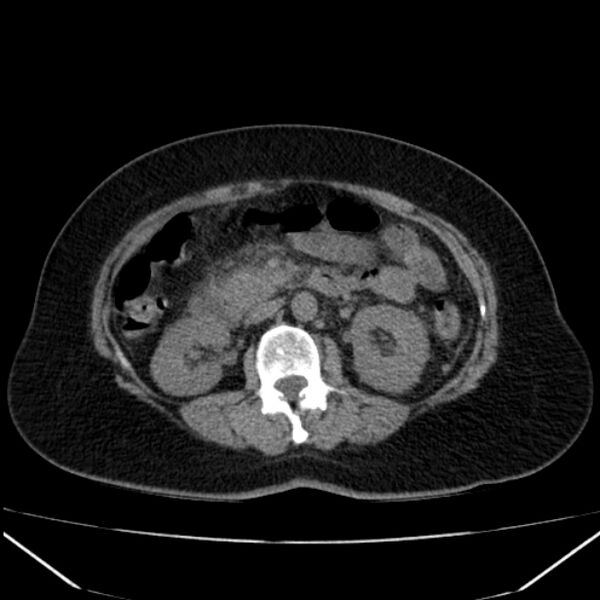 File:Acute pancreatitis - Balthazar C (Radiopaedia 26569-26714 Axial non-contrast 43).jpg