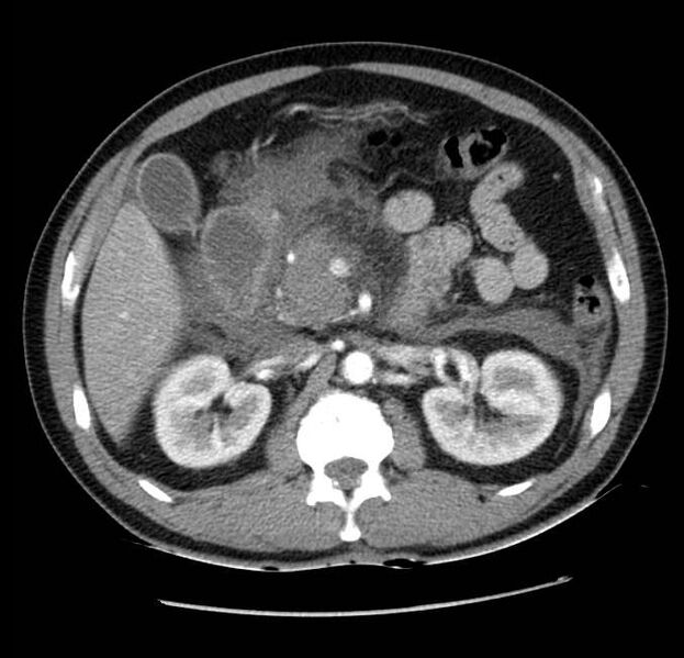 File:Acute pancreatitis - Balthazar E (Radiopaedia 23080-23110 Axial C+ arterial phase 26).jpg