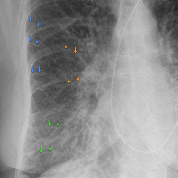 File:Acute pulmonary edema (Radiopaedia 15434-15233 A 1).png