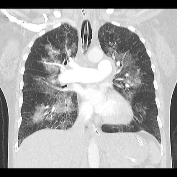 File:Acute pulmonary edema on CT (Radiopaedia 33582-34672 Coronal lung window 18).jpg