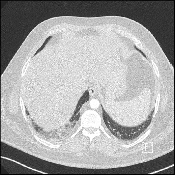 File:Acute pulmonary embolism with pulmonary infarct (Radiopaedia 73062-83768 Axial lung window 22).jpg