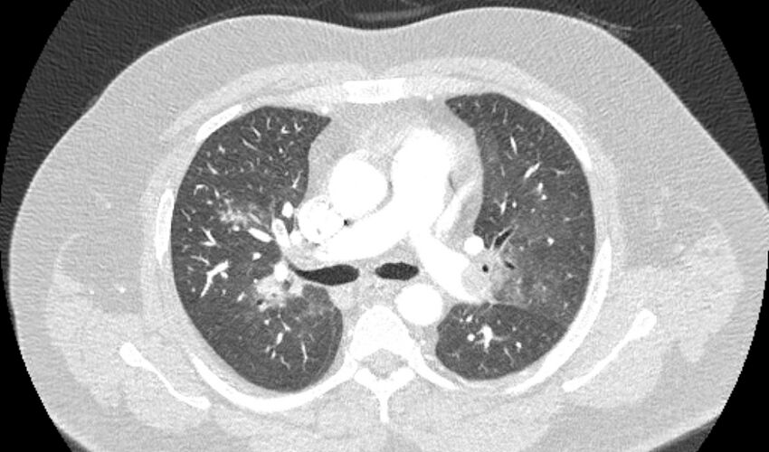 Acute pulmonary embolism with pulmonary infarcts (Radiopaedia 77688-89908 Axial lung window 45).jpg