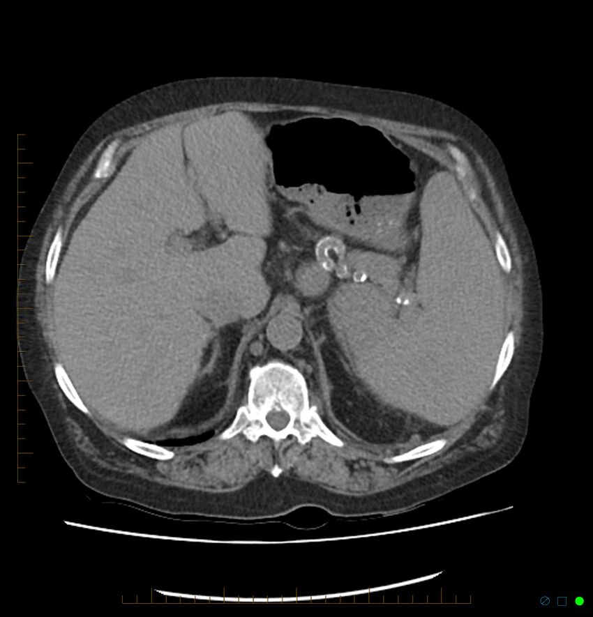 Acute renal failure post IV contrast injection- CT findings (Radiopaedia 47815-52557 Axial non-contrast 20).jpg