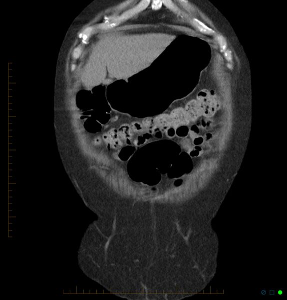 File:Acute renal failure post IV contrast injection- CT findings (Radiopaedia 47815-52557 Coronal non-contrast 3).jpg