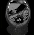 Acute renal failure post IV contrast injection- CT findings (Radiopaedia 47815-52557 Coronal non-contrast 6).jpg