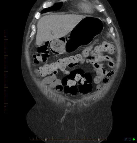 File:Acute renal failure post IV contrast injection- CT findings (Radiopaedia 47815-52557 Coronal non-contrast 6).jpg