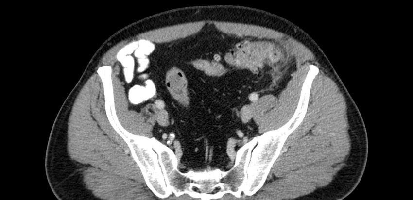 Acute sigmoid colon diverticulitis (Radiopaedia 55507-61976 Axial C+ portal venous phase 83).jpg