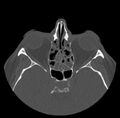 Acute sinusitis (Radiopaedia 23161-23215 Axial bone window 43).jpg