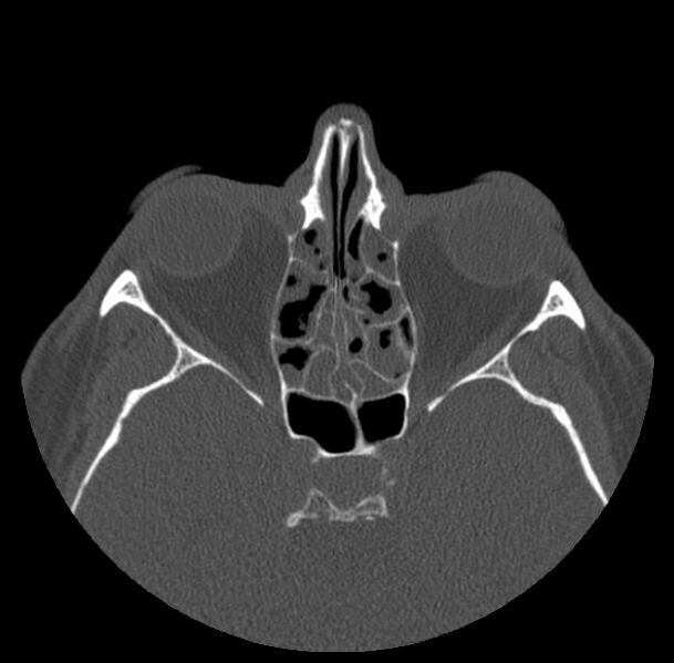File:Acute sinusitis (Radiopaedia 23161-23215 Axial bone window 43).jpg