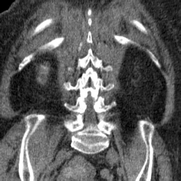 File:Acute tubular necrosis (Radiopaedia 28077-28334 C 31).jpg