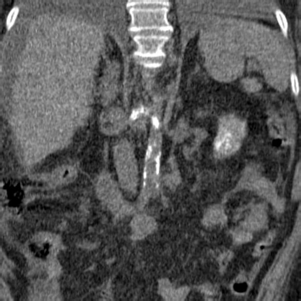 File:Acute tubular necrosis (Radiopaedia 28077-28334 Coronal non-contrast 5).jpg