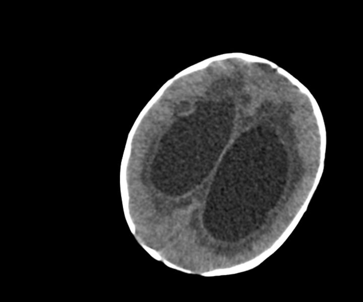 File:Acute ventriculitis (Radiopaedia 57502-64459 Axial non-contrast 13).jpg