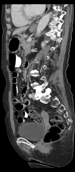 File:Adenocarcinoma of cecum (Radiopaedia 59222-66549 Sagittal C+ portal venous phase 36).jpg