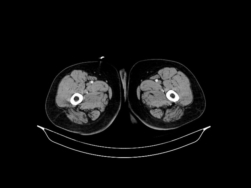 File:Adenocarcinoma of pancreas with hepatic metastasis (Radiopaedia 64332-73122 Axial C+ portal venous phase 119).jpg