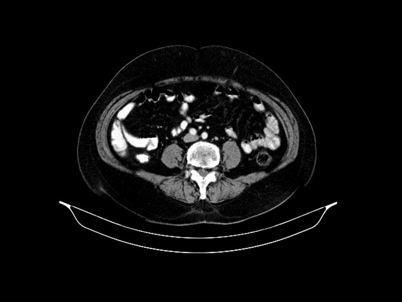 File:Adenocarcinoma of pancreas with hepatic metastasis (Radiopaedia 64332-73122 Axial C+ portal venous phase 65).jpg