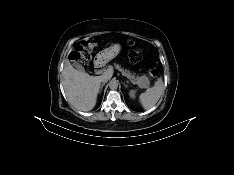 File:Adenocarcinoma of pancreas with hepatic metastasis (Radiopaedia 64332-73122 Axial non-contrast 31).jpg