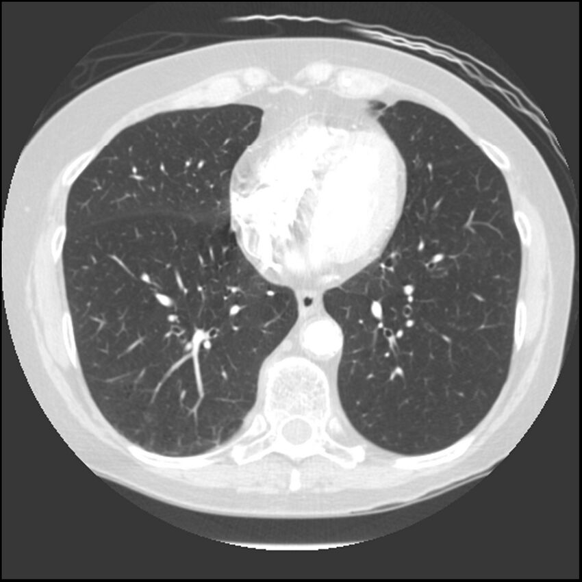 Adenocarcinoma of the lung (Radiopaedia 41015-43755 Axial lung window 83).jpg