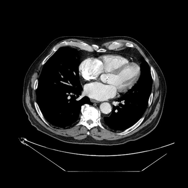 File:Adenocarcinoma of the lung (Radiopaedia 44876-48759 Axial C+ portal venous phase 53).jpg