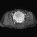 Adenomyoma of the uterus (huge) (Radiopaedia 9870-10438 Axial T1 C+ fat sat 15).jpg