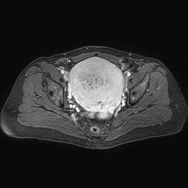 File:Adenomyoma of the uterus (huge) (Radiopaedia 9870-10438 Axial T1 C+ fat sat 15).jpg