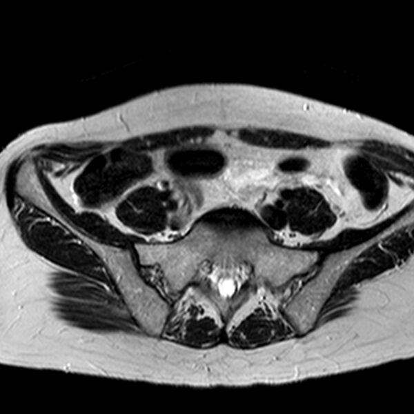 File:Adenomyoma of the uterus (huge) (Radiopaedia 9870-10438 Axial T2 35).jpg