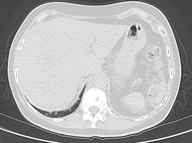 File:Adenosquamous lung carcinoma (Radiopaedia 22035-22030 lung window 56).jpg
